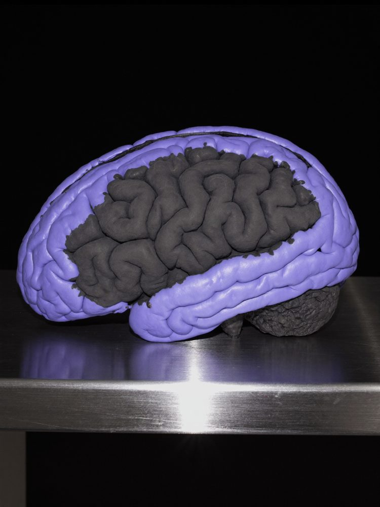 A brain with the deep centre dark and drained