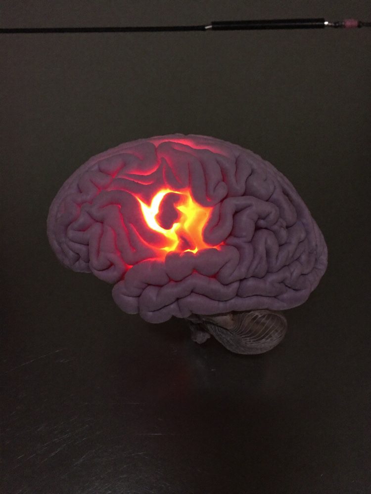 A brain with one deep region glowing hot like an ember
